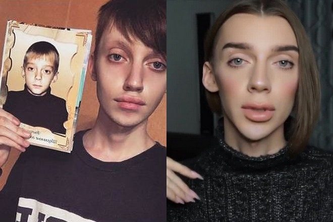 Андрей Петров до и после пластики